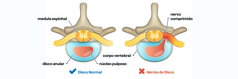 Ilustração do disco normal e disco com hérnia.